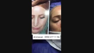جراحی زیبایی بینی توسط متخصص گوش و حلق و بینی
