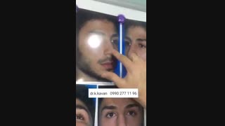 جراحی بینی توسط دکتر کیوان کاوان هایفوتراپی