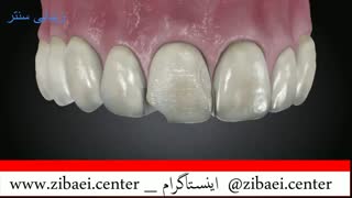 کامپوزیت دندان,پر کردن دندان یا روکش دندان,داندان پزشکی در زیبایی سنتر