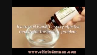 درمان خانگی کیست مویی یا سینوس پیلونیدال - کلینیک پایتخت