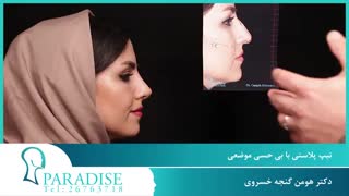 عمل زیبایی بینی (تیپ پلاستی) به روش دکتر گنجه خسروی در کلینیک تخصصی پارادایس پروتز سینه