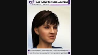 ارتودنسی همراه با جراحی فک | دکتر فاضل فیروزی