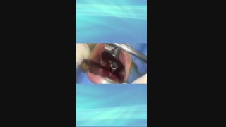 درمان بوی بد دهان