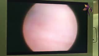 افزایش ضخامت اندومتر