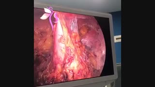 لاپاراسکوپی چسبندگی شدید لگنی