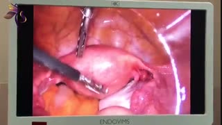 لاپاراسکوپی کیست تخمدان در دختر 16 ساله