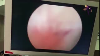 لکه بینی و پولیپ رحم
