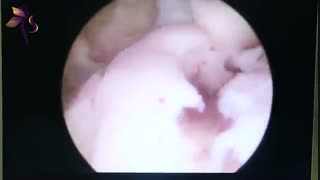 هیستروسکوپی در خانم 40 ساله