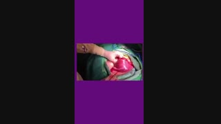 در آوردن میوم رحمی ۸ سانت