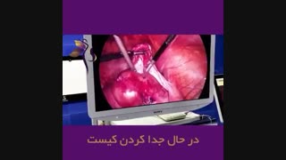 لاپاراسکوپی کیست درمویید و میوم رحمی