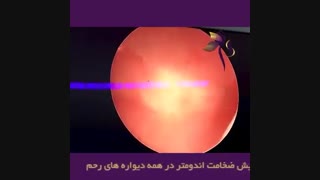 عمل هیستروسکوپی و افزایش ضخامت اندومتر رحم