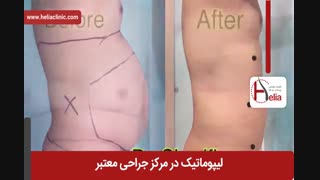 لیپوماتیک | فیلم لیپوماتیک | کلینیک پوست و مو هلیا | شماره 7