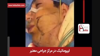لیپوماتیک | فیلم لیپوماتیک | کلینیک پوست و مو هلیا | شماره 9