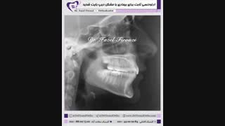 ارتودنسی بیمار با دیپ بایت شدید | دکتر فیروزی