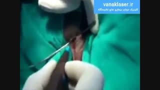 درمان فیستول به صورت تضمینی و بدون درد و بدون بازگشت در ونک لیزر https://vanaklaser.ir/