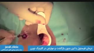 درمان فیستول با لیزر بدون بازگشت و عوارض در کلینیک نوین