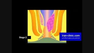 شناخت بیماری بواسیر یا هموروئید و علل بروز این بیماری در ایران کلینیک