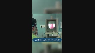 فیلم جراحی اندوسکوپی سینوس، خارج کردن پولیپ