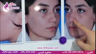 عمل زیبایی بینی