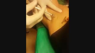بوتاکس - 22807060
