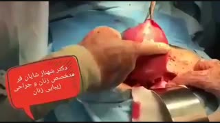 ازاله الورم اللیفی