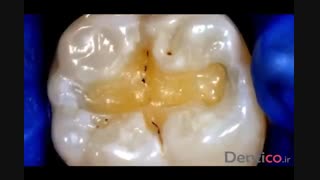 کامپوزیت رزینی TOKUYAMA ESTELITE SIGMA QUICK