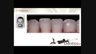 کامپوزیت  Vit-l-escence کمپانی Ultradent