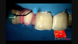 کامپوزیت  رزینی  TOKUYAMA ESTELITE SIGMA QUICK