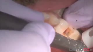 کامپوزیت  VOCO - Grandio SO