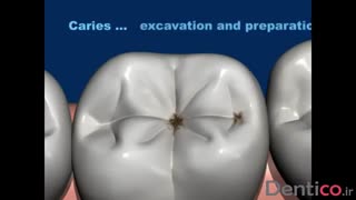 کامپوزیت   VOCO - Grandio SO