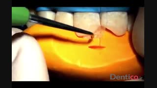 کامپوزیت رزینی TOKUYAMA ESTELITE SIGMA QUICK