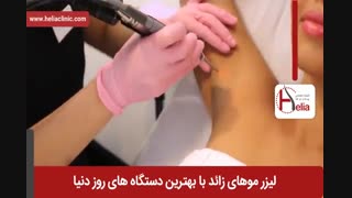 لیزر موهای زائد | فیلم لیزر موهای زائد | کلینیک پوست و مو هلیا | شماره 11