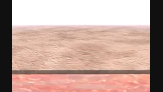 لیزر موهای زائد | فیلم لیزر موهای زائد | کلینیک پوست و مو هلیا | شماره 12