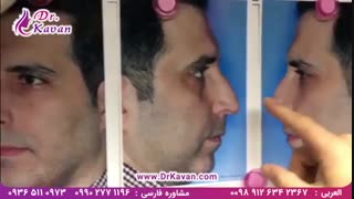 عمل بینی توسط دکتر کاوان