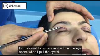 جراحی پلک همزمان با جراحی بینی قسمت اول
