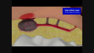 درمان فیستول با لیزر و جراحی بدون بازگشت در ایران کلینیک