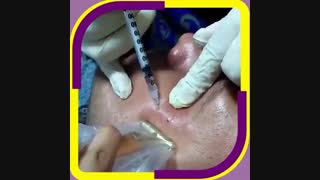 فیلم تزریق بوتاکس دور چشم