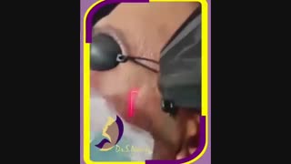 لیزر فرکشنال