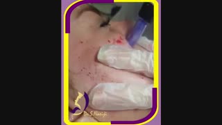 میکرونیدلینگ صورت