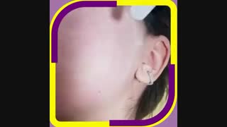 میکرودرم ابریشن