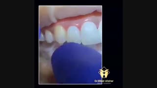 مراحل کامپوزیت دندان