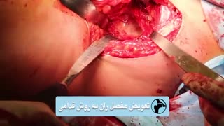 فیلم تعویض مفصل ران به روش قدامی