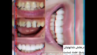 نمونه کار های دکتر سحر میرآبا: اصلاح طرح لبخند، فرم زیبای دندان ها