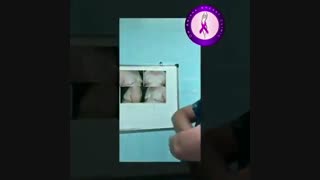 جراحی ژنیکوماستی در بیمار با کاهش وزن شدید