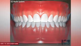 شیوه قرار گرفتن ارتودنسی دندان در دهان