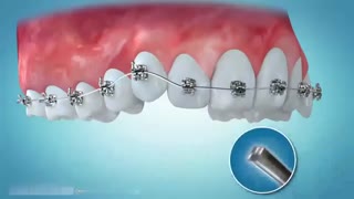 انواع ارتودنسی دندان