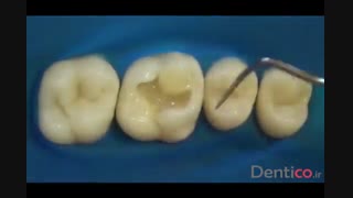 کامپوزیت  KULZER CHARISMA FLOW