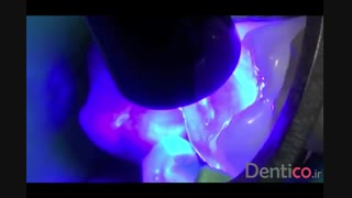 کامپوزیت کوربیلدآپ GC everX posterior