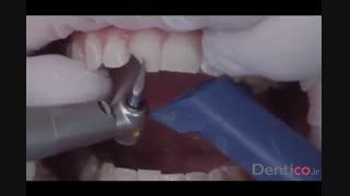 Charisma  Diamond  کامپوزیت