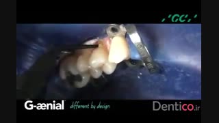 کامپوزیت GC G- aenial Flo